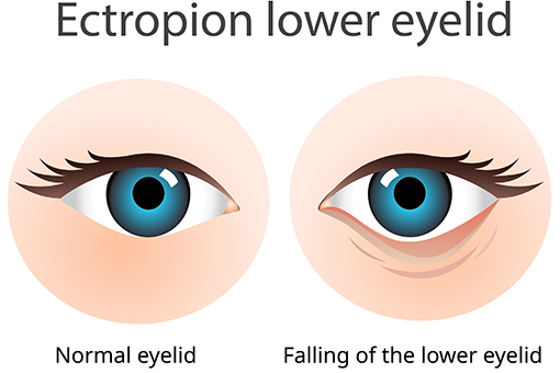 Diagram of lower lid ectropion