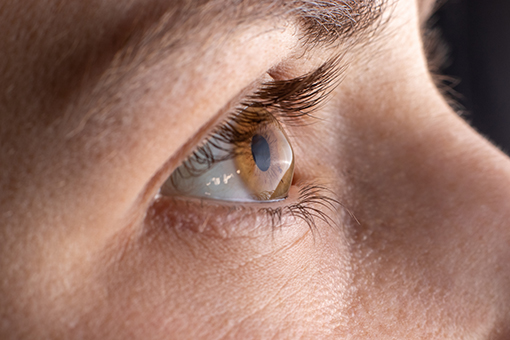 Close up photo of a cornea effected by Keratoconus