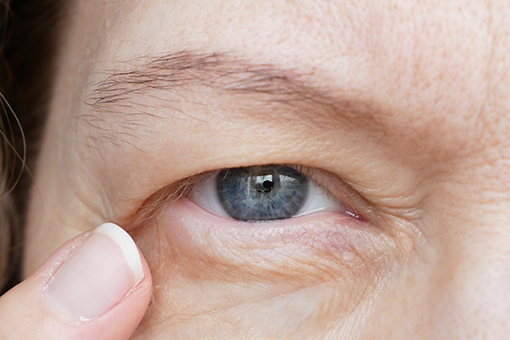 Middle aged woman with ptosis